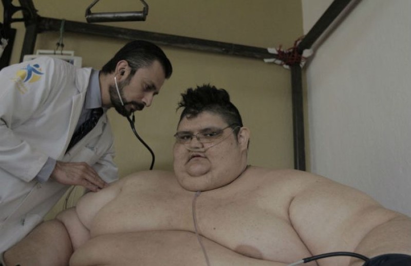 El hombre ‘más obeso del mundo’ permanece estable tras bajar 281 Kilos por bypass gástrico